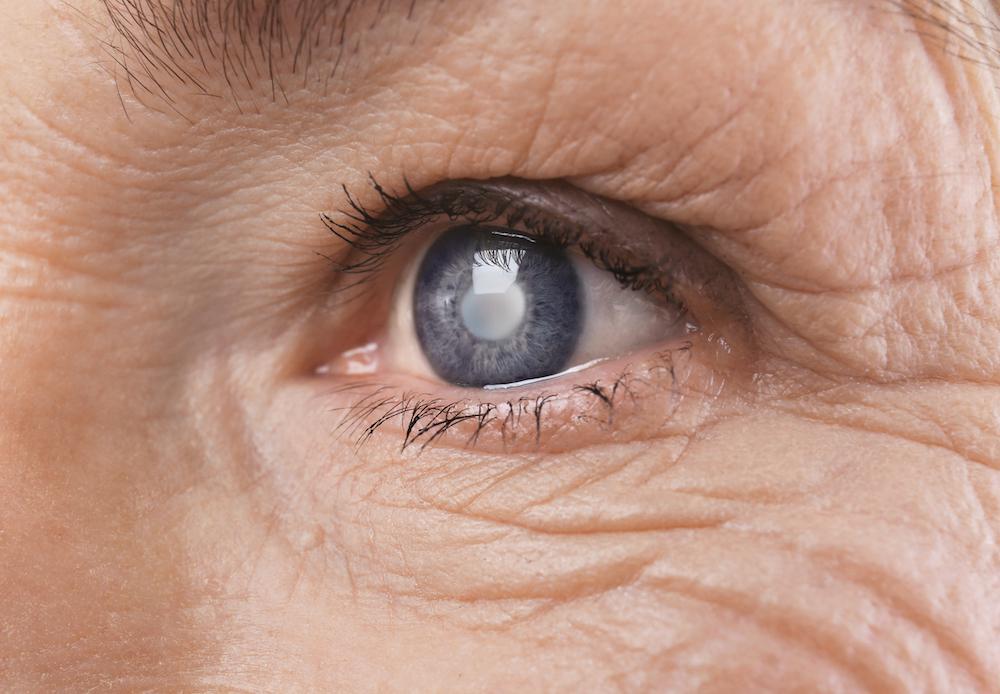 older womans eye zoomed in with a clouded cornea from cataracts