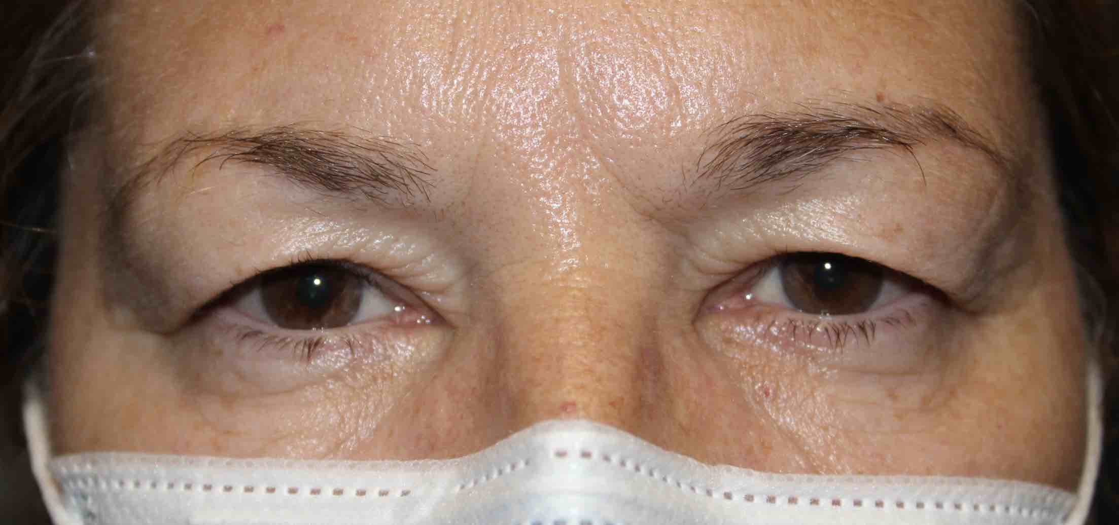 57 year old female before surgical upper blepharoplasty