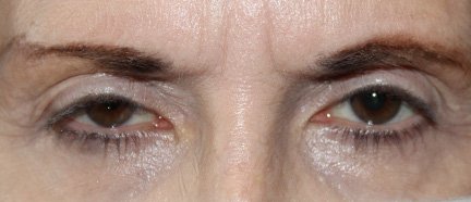 49 year old female before ptosis repair surgery