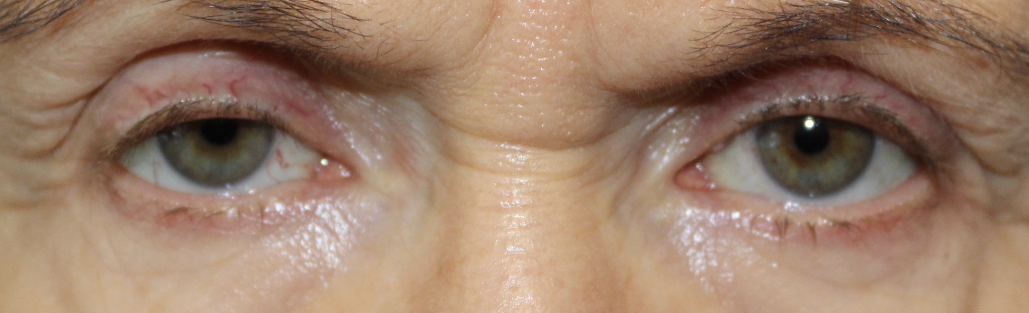 female patient bilateral ptosis repair