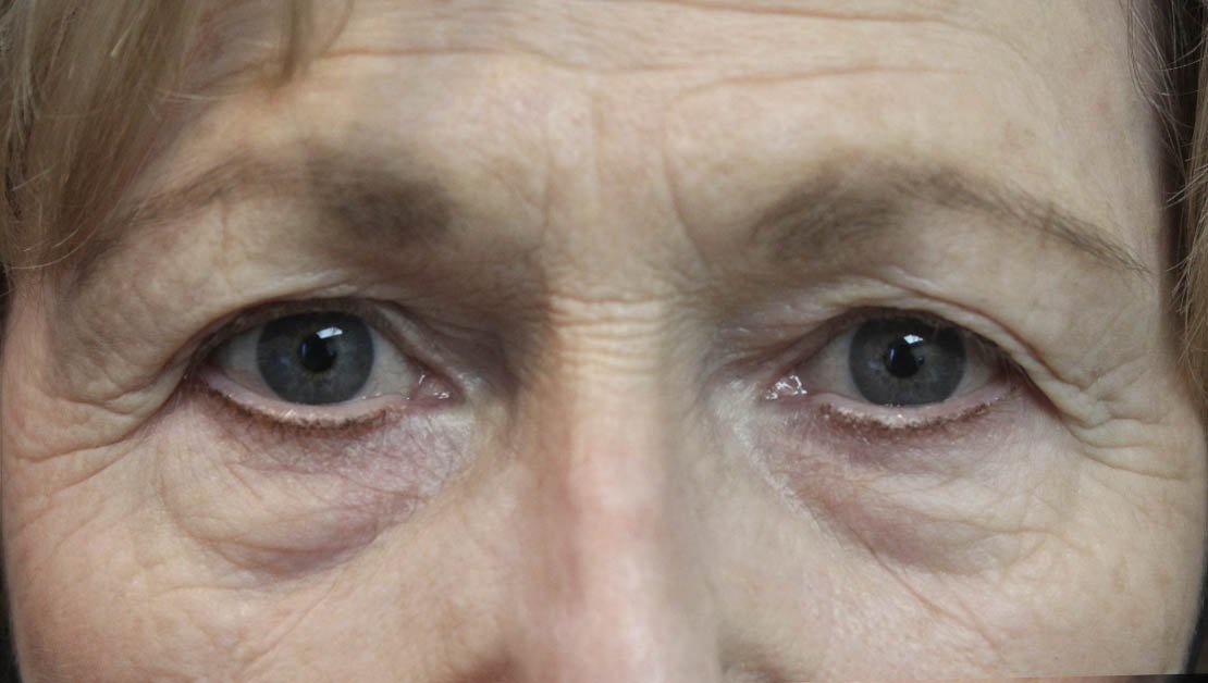 68 year old female before upper blepharoplasty surgery