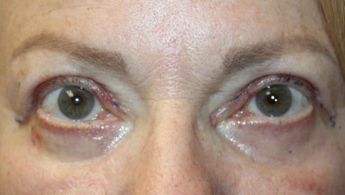 69 year old woman looking ahead 1 week after blepharoplasty procedure