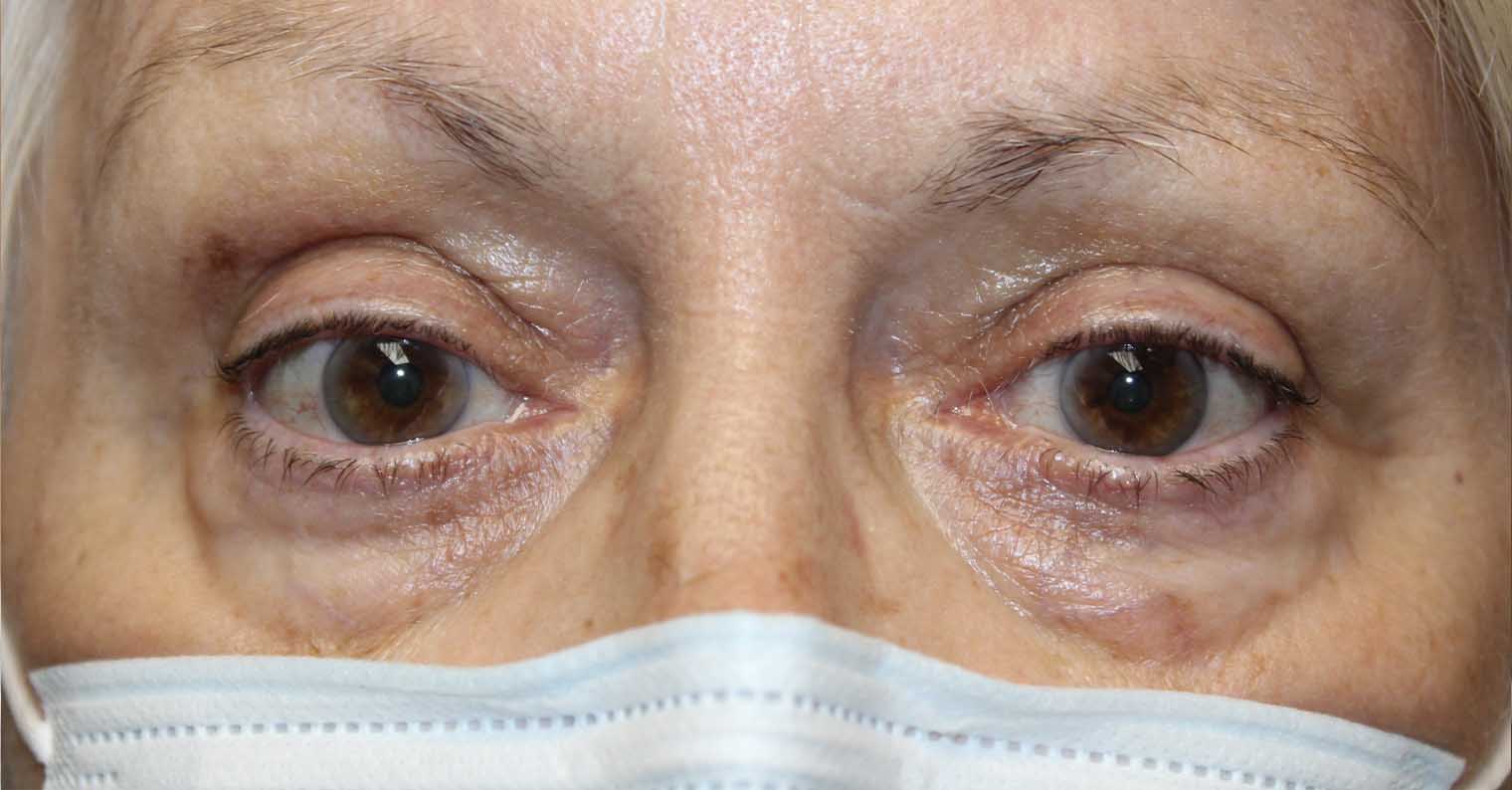 Womans eyes after thyroid eye disease repair