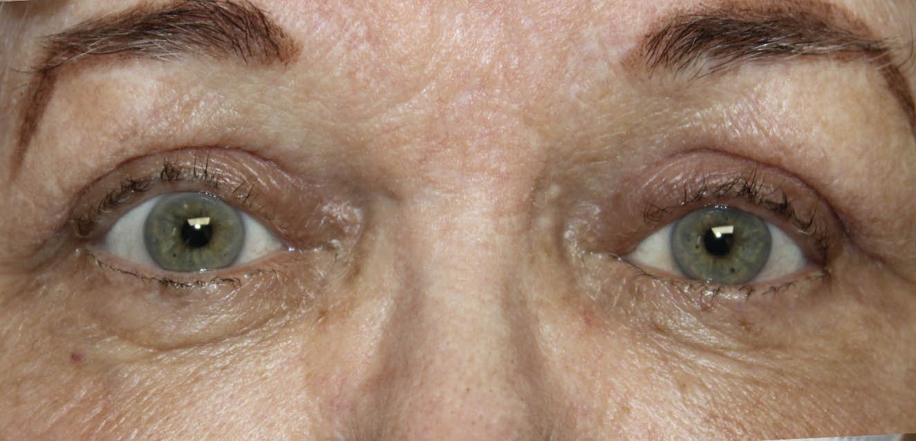 ptosis repair in 81 year old male