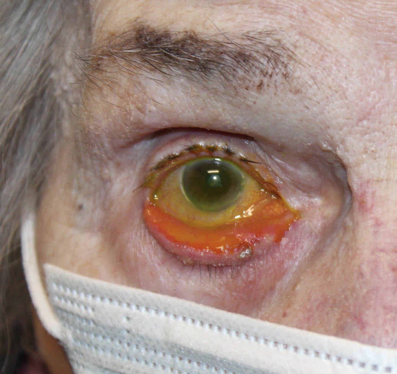 91 year old woman ectropion repair surgery example