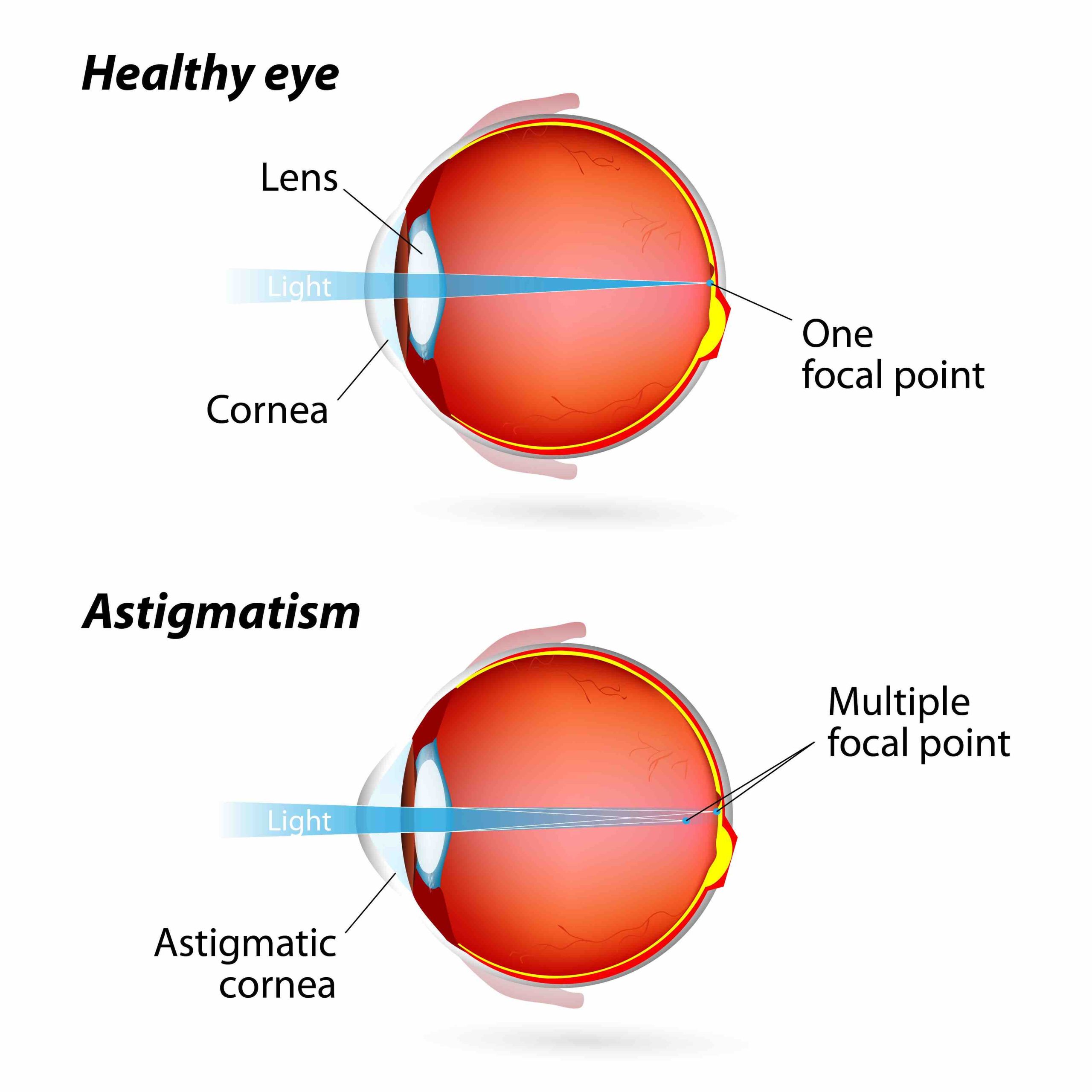 a healhty eye vs. an eye with astigmatism and how light focuses through the cornea