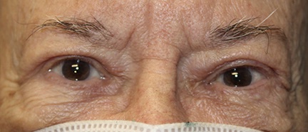 male upper blepharoplasty procedure