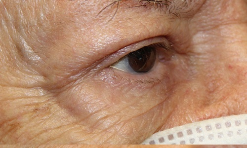 male blepharoplasty procedure results