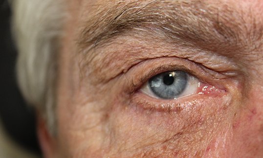 entropion repair on male eye results