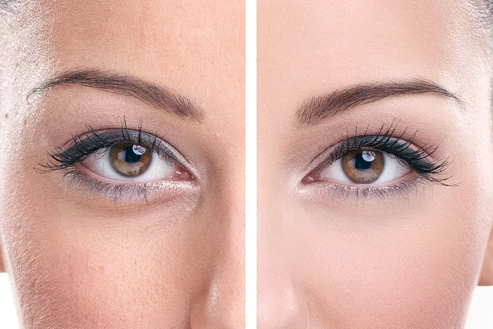 Close up of womans eyes before and after oculoplastic surgery