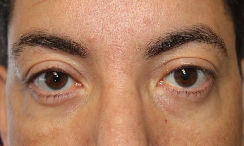 lower blepharoplasty results on male patient