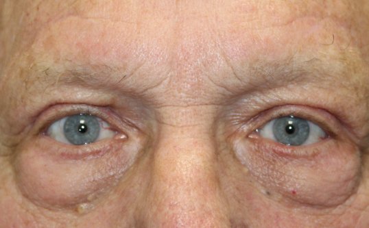 male before blepharoplasty surgery