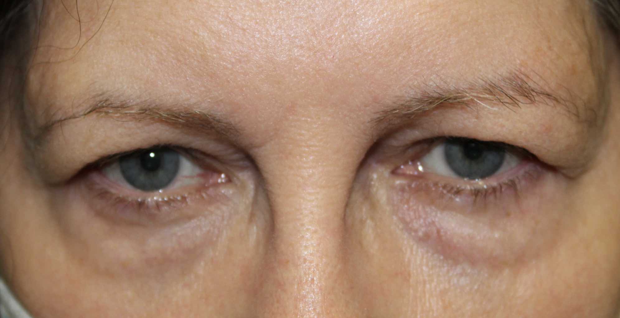 woman before blepharoplasty on the upper eye