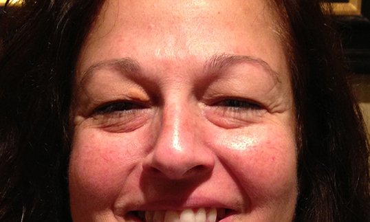 female before surgery blepharoplasty