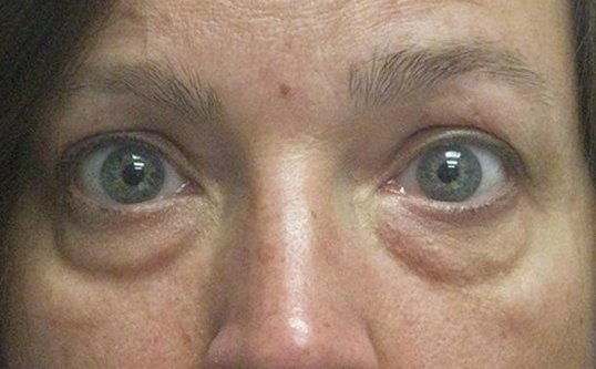 before a lower eyelid blepharoplasty