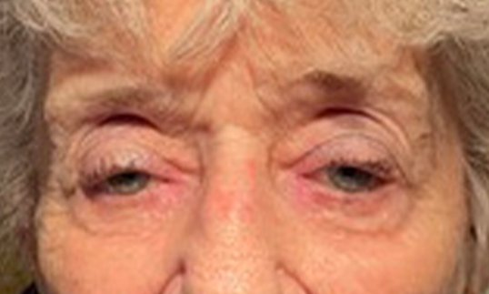 older female patient before ptosis repair