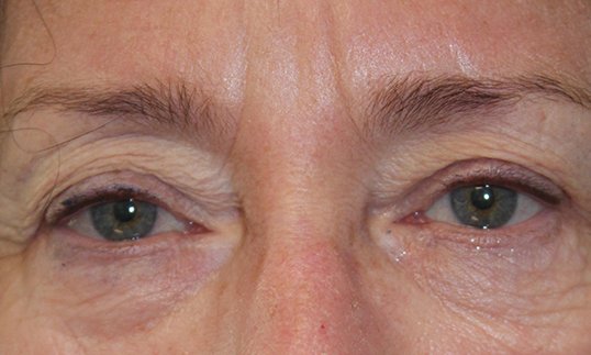 female patient before ptosis repair surgery