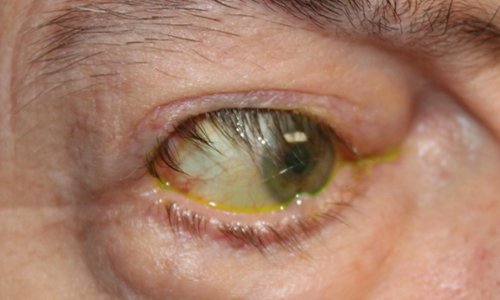 mans eye before eyelid retraction