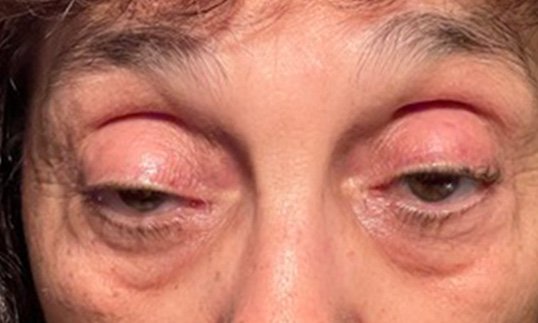 older female patient before ptosis repair