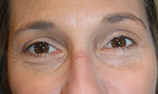 ptosis repair after on female patient