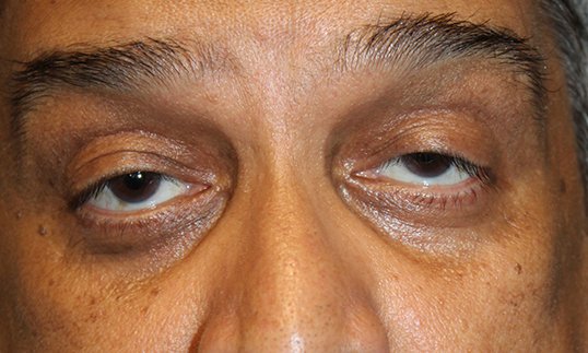 before ptosis surgery on female patient