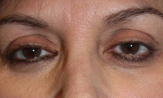 ptosis repair on female patient before the procedure