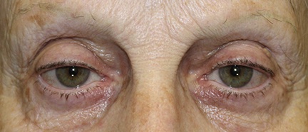 woman before ptosis repair surgery